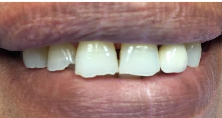 Smile with chipped top teeth